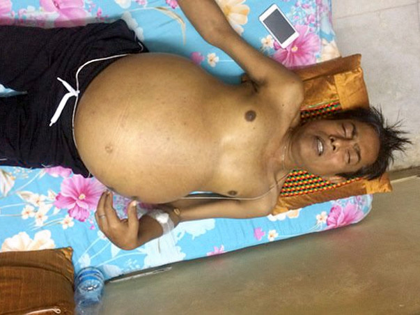 Help My Father Undergo Liver Transplant