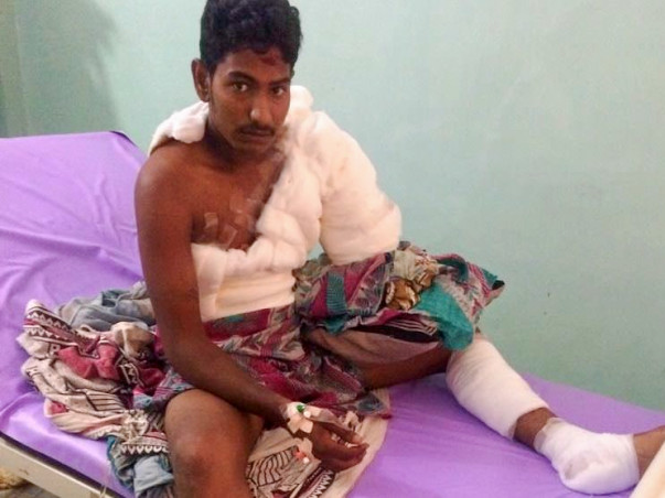 Help For Suresh's Surgery - Accidental Current shock - Kakinada