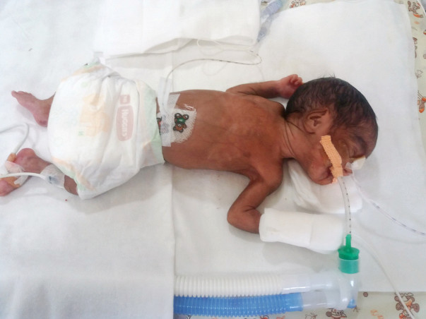 Help twin babies of Ramani get ventilator support