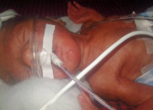 Help premature baby boy