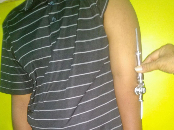 Help 19-Year-Old Mohammed Find An Elbow