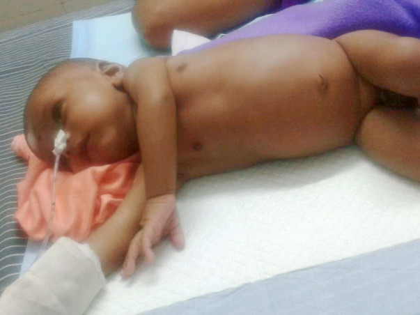 Save Little 2-Month's Old Baby From Hirschsprung Disease