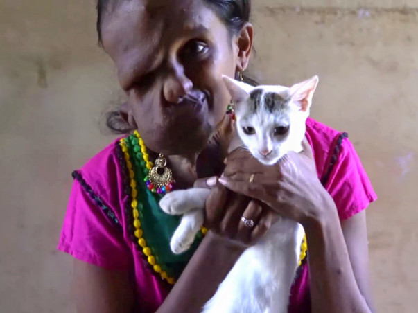 A Rare Disease Has Melted This 24-Yr-Old Chennai Woman’s Face