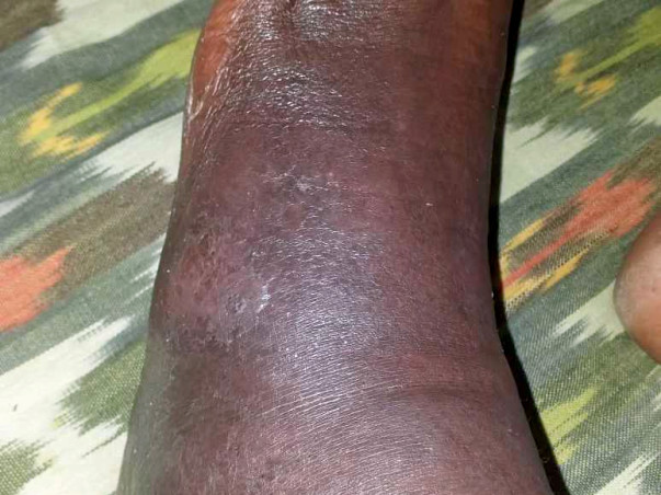 Support N.Srinivas Recover From Cellulitis