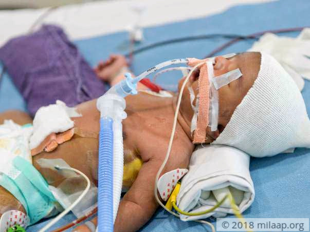 "My 2-week-old Baby Is Fighting To Stay Alive After A Heart Surgery"