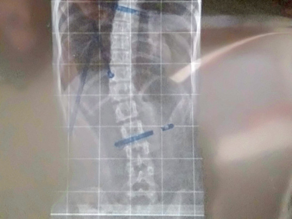 Help greeshma (spinal bend surgery)