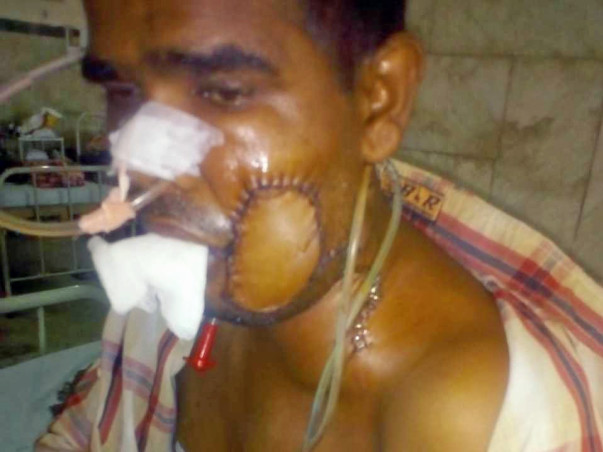 Support Mukesh Kumar Singh recover from Oral Cancer