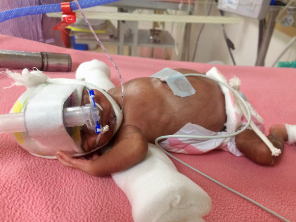 Help for my pre-mature baby
Born in 25th week