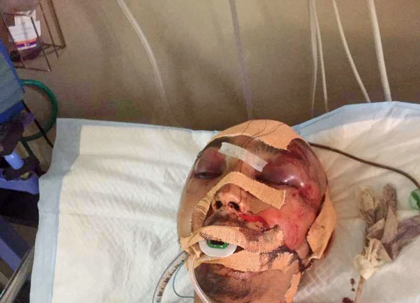 Help Darshan Recover From A Serious Accident