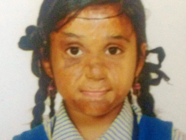 Madhupriya Needs Your Help To Recover From Severe Burns