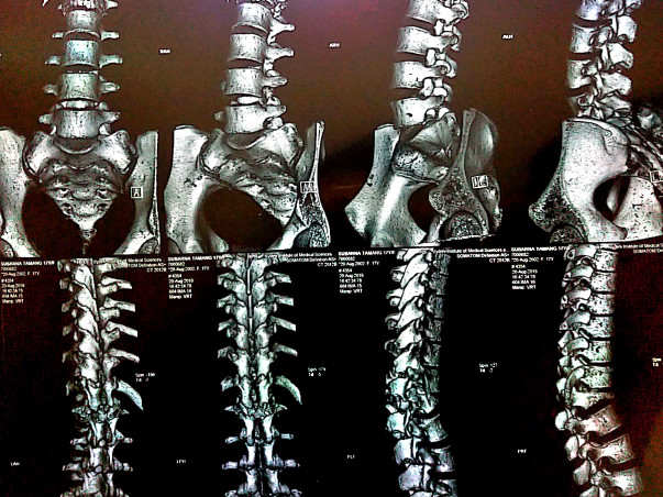 Help Subarna suffering from Spinal Cord Injury