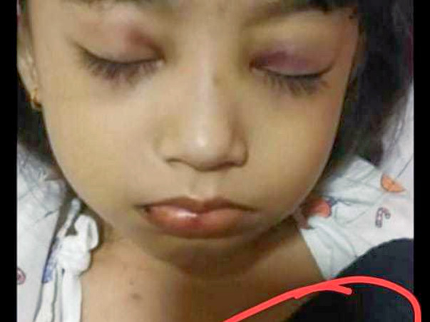Help Bristi Deka to Fight Leukemia (Blood Cancer)