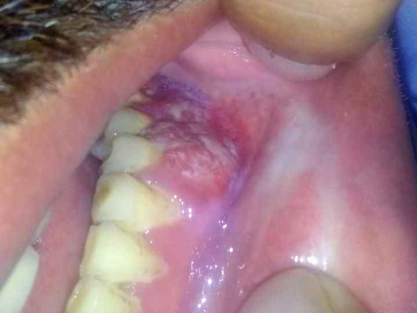 38 Years Old Gaurav Tiwari Needs Your Help Fight Oral Cancer