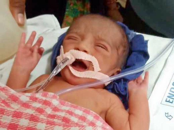 Help 1-day-old Baby Recover From Respiratory Issues