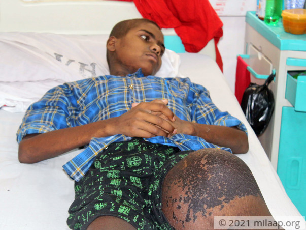 A Large Cancerous Tumor Will Kill This 14-Year-Old Without Urgent Help