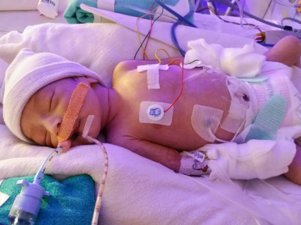 Help My Newborn Baby Girl Fight Congenital Heart Defect - HLHS