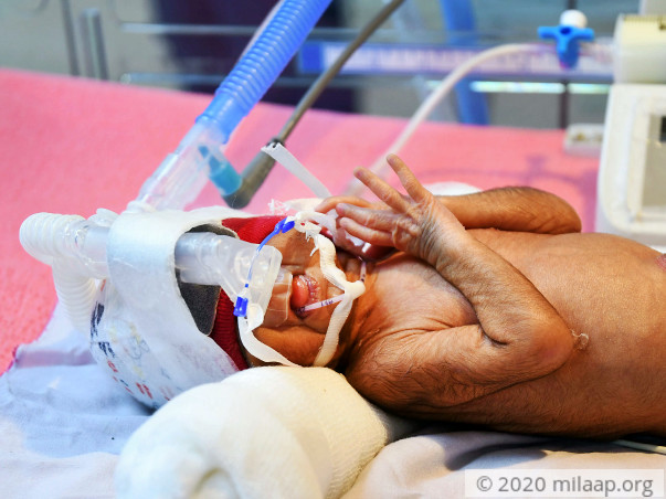 Help Kamala and Kallan save their premature twins