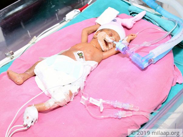 Baby of Santosh needs your help to fight disease