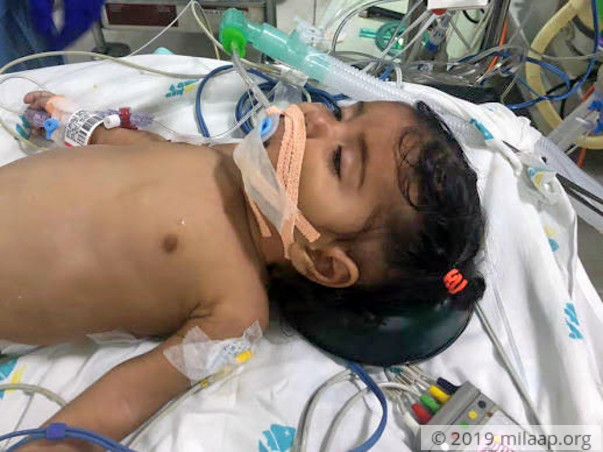 5-month-old Anjali has only 49% Oxygen Level, Needs Heart Surgery