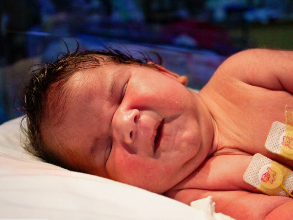 15-day-old baby with hole in the back needs urgent surgery