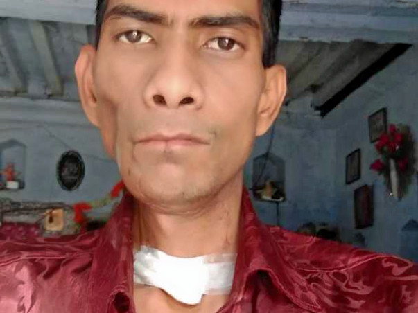 Help Ashok Recover From Mouth Cancer