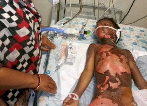 6 Year old kid Moiz Burnt Grievously in contact with high tension wire