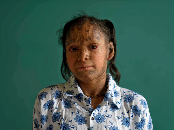 Help this 13-year-old girl fight a life of skin infections