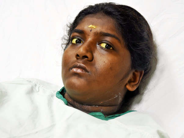 These Parents Cannot Even Buy Medicines For Daughter's Liver Disease