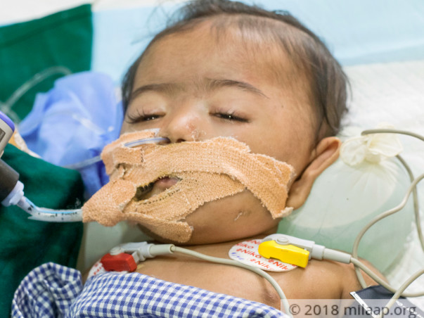 This 7-month-old cannot exhale on her own and needs urgent treatment
