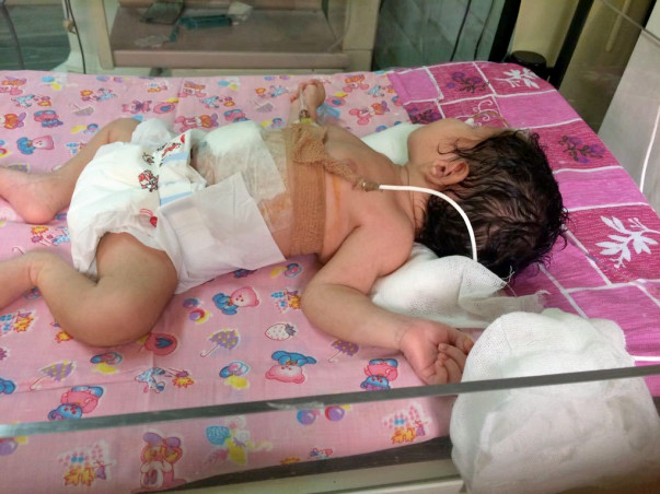 Help Pooja's New Born Baby went through Intestinal Obstruction Surgery