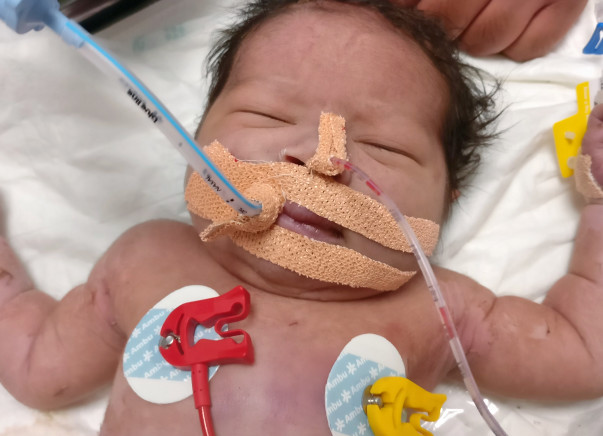 Baby of Reshma need our Help