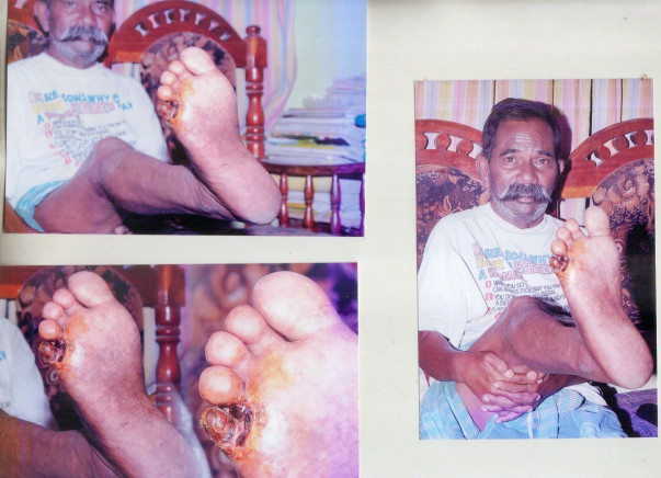Help me to fight blocked veins ( Right leg to Heart )