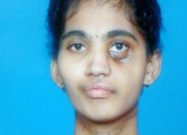 Help Jyothi undergo radiotherapy