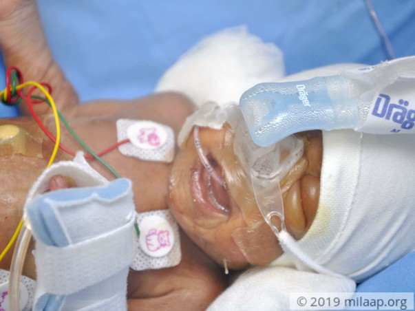 Helpless Mother Struggles To Save Her Newborn Twins