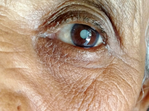 Help Me To Undergo An Eye Surgery