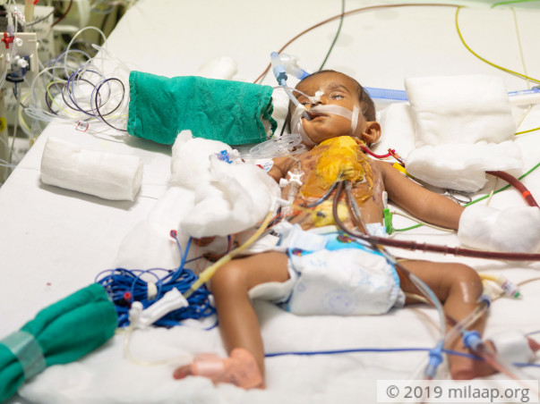 Help Baby of Mallesh Fight Congenital Heart Disease