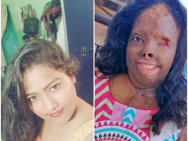 Help Zakira Recover From Acid-Attack