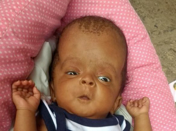 Help Baby Deepidi having blockage in one nerve in head