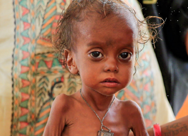 You can save the lives of 40 malnourished children