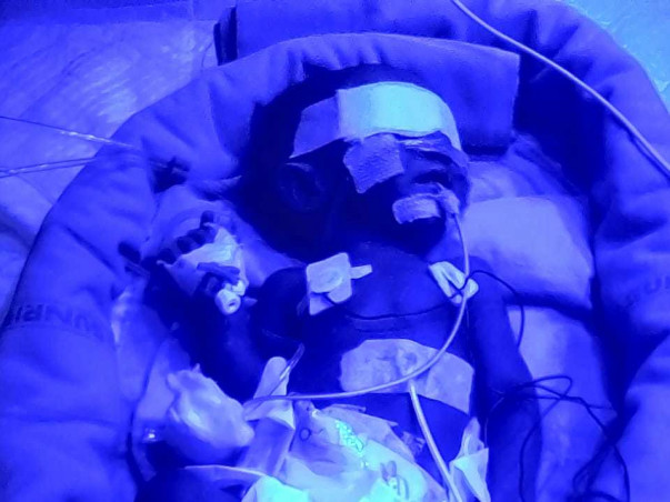 Help A Baby Undergo A Lung Surgery