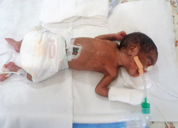 Help twin babies of Ramani get ventilator support