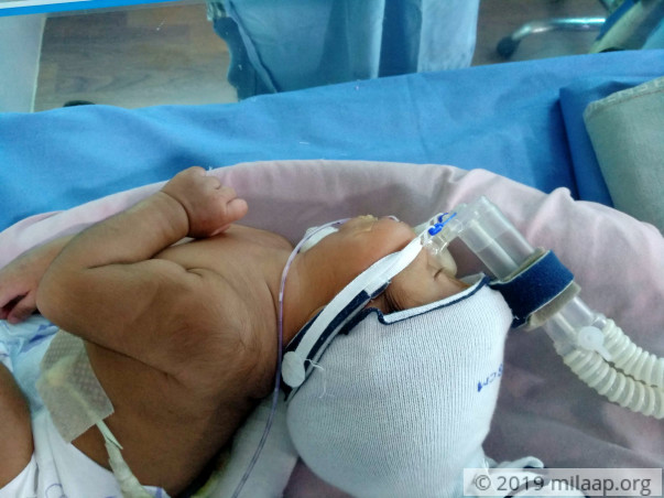 Help baby of Kala Prabha who is in urgent need of a surgery