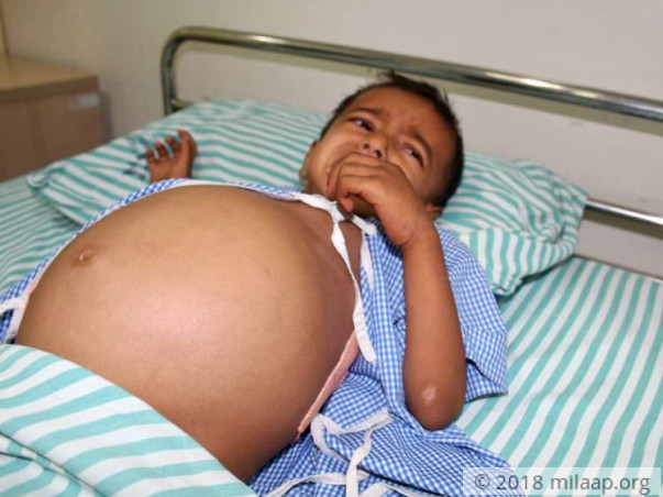 Baby's Stomach Has Swollen To The Size Of A Football Because Of Cancer