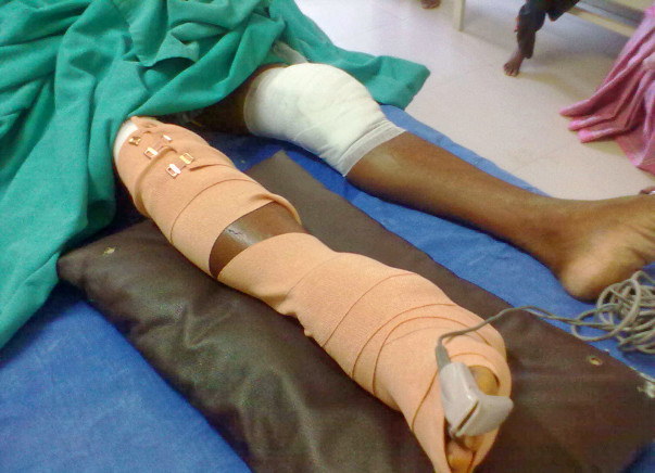 Help for Mariyappann, a victim of road accident