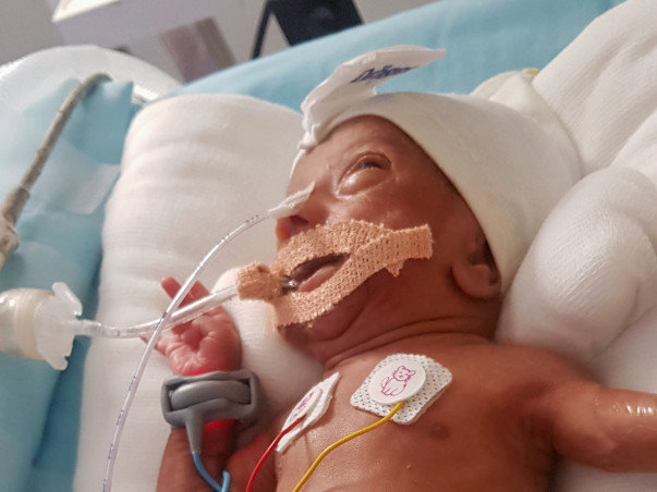 Help Baby Of Shalini: Premature Birth