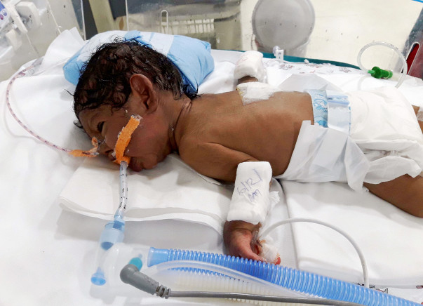 Help baby of Noorjahan undergo gastrostomy surgery
