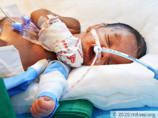 Premature Baby Girl With Underdeveloped Vital Organs Needs Urgent Help