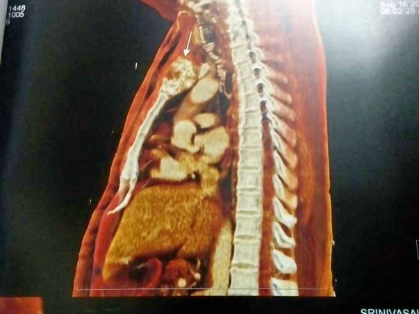 Help My Father Recover From Bone tumor