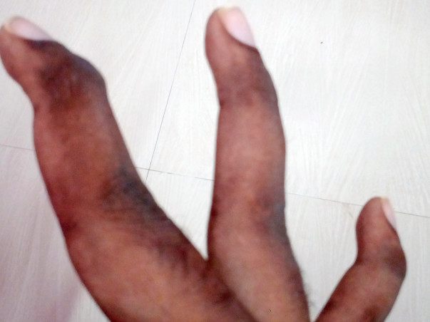 I’m struggling with Fractured fingers, help me