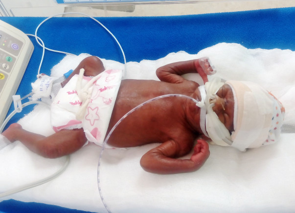 Help Ganesh To Save His 26-Week-Old Son